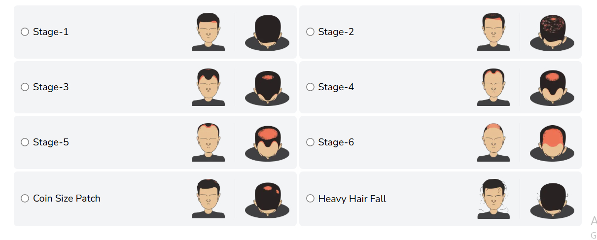 Hair Loss Stages