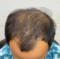 Sample Scalp Photo